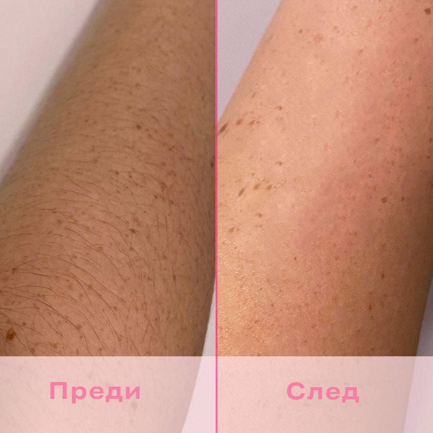 Lumi – IPL фотоепилатор